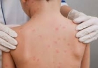Centro Estadual de Vigilância em Saúde emite alerta epidemiológico para surto de meningite no Sul do RS