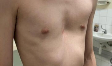 Técnica inédita no HCPA é usada em cirurgia de criança