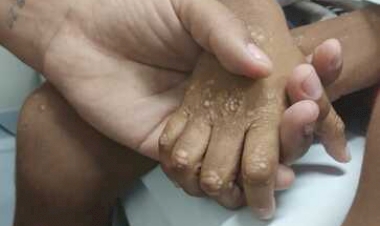 Hospital de Clínicas chega à marca de 300 transplantes hepáticos pediátricos