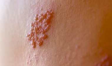 Associação Médica do Rio Grande do Sul destaca importância da vacinação contra herpes-zoster