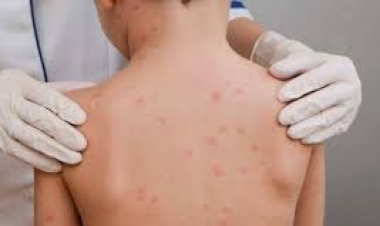 Centro Estadual de Vigilância em Saúde emite alerta epidemiológico para surto de meningite no Sul do RS