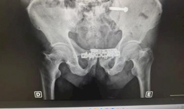 Complexo Hospitalar Unimed Erechim realiza sua primeira cirurgia de reconstrução de bacia