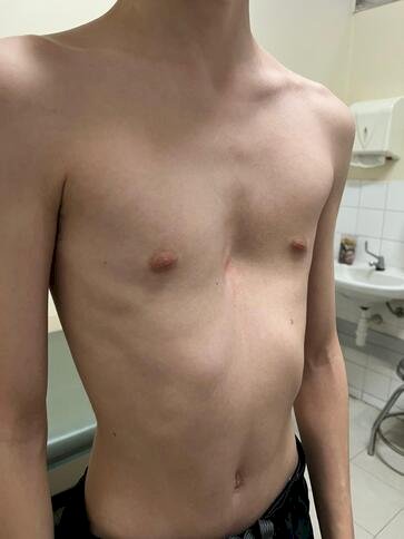 Técnica inédita no HCPA é usada em cirurgia de criança