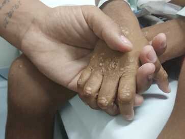 Hospital de Clínicas chega à marca de 300 transplantes hepáticos pediátricos