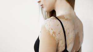 Vitiligo: doença não tem cura, mas opções de tratamento podem impedir sua evolução.
