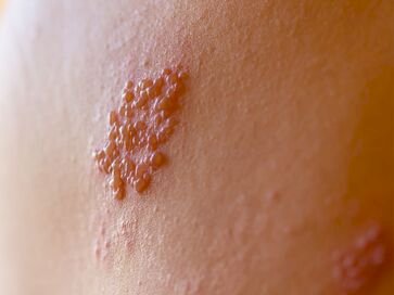 Associação Médica do Rio Grande do Sul destaca importância da vacinação contra herpes-zoster