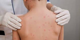 Centro Estadual de Vigilância em Saúde emite alerta epidemiológico para surto de meningite no Sul do RS